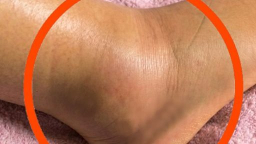 If you notice your legs are swollen, that’s a sign of ca…