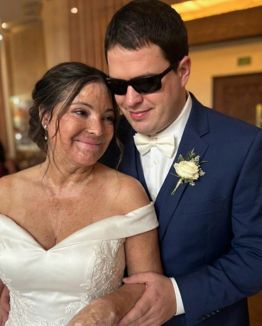I Married a Blind Man So He’d Never See My Scars – On Our Wedding Night, He Said, ‘You Need to Know the Truth I’ve Been Hiding for 20 Years’